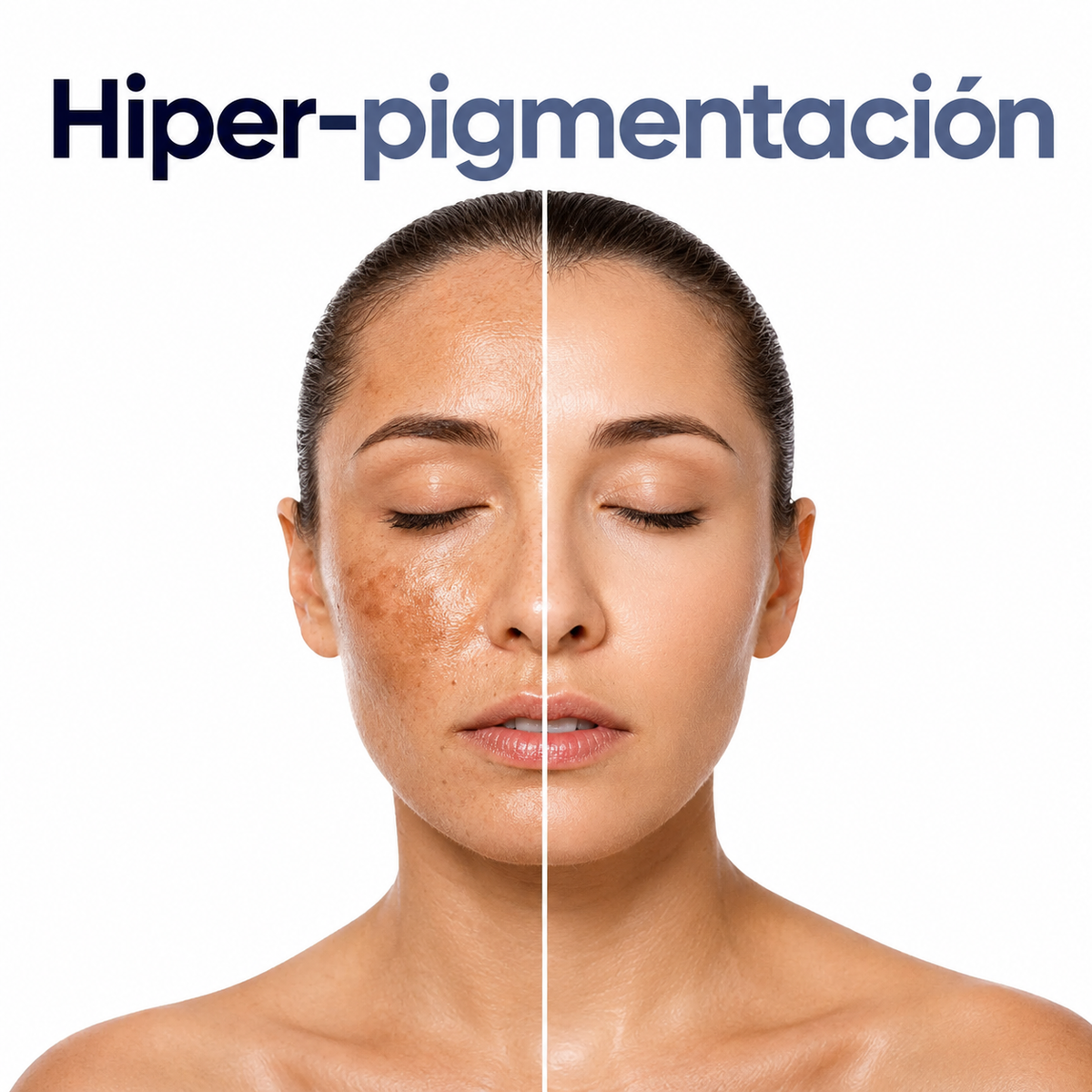 Hiper-pigmentación