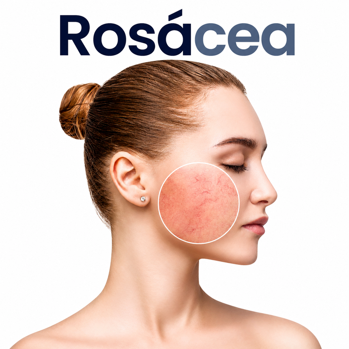 Rosácea